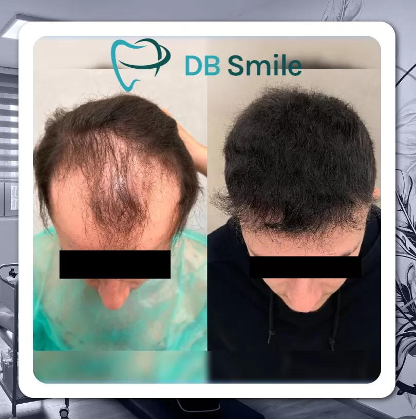 Trapianto di capelli Trapianto di capelli
